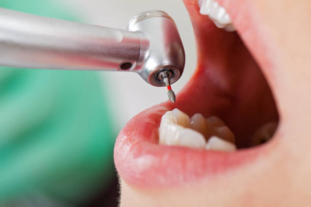 Best Emergency Tooth Extraction in Hallowell, ME